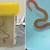 Mysterious Medical Case Unraveled: Parasitic Worm Discovered Wriggling in Woman’s Brain