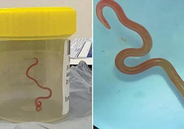 Mysterious Medical Case Unraveled: Parasitic Worm Discovered Wriggling in Woman’s Brain